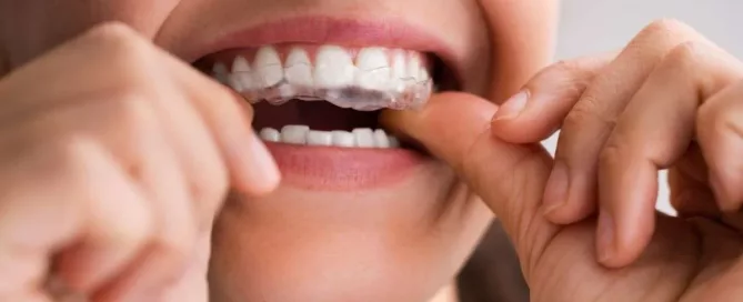 Clear Aligners in Newry OHagan Murray Dental Practice