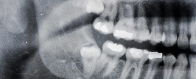 KSD The Wisdom Tooth Removal Doet