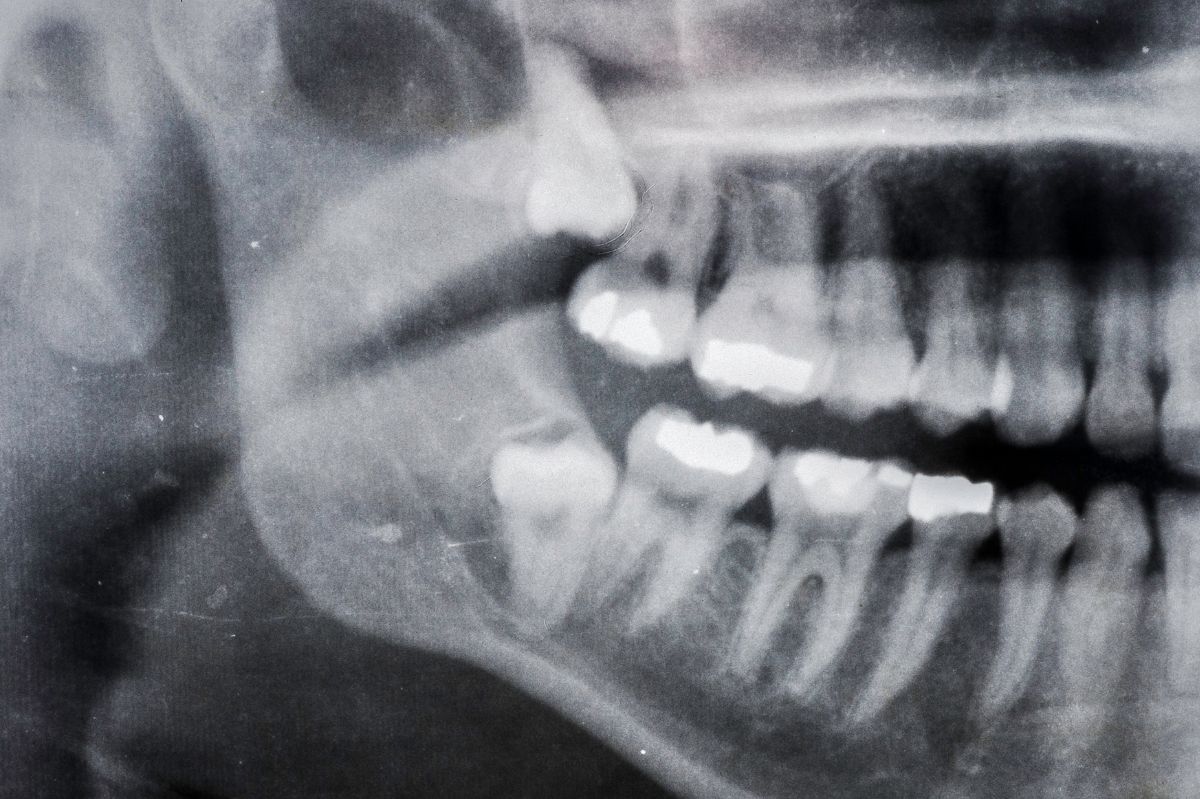 How Long Does Wisdom Teeth Extraction Take 