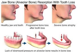 Jawbone Deterioration Begins (Bone Loss)